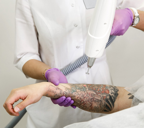 Wart Removal